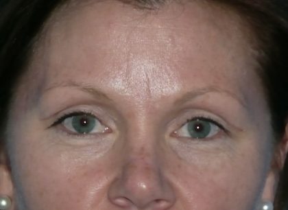 Blepharoplasty Before & After Patient #1394