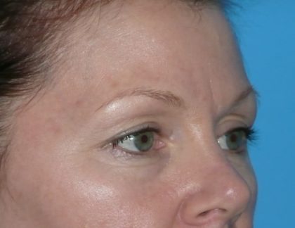 Blepharoplasty Before & After Patient #1394