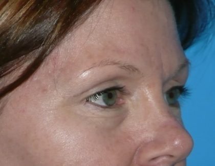 Blepharoplasty Before & After Patient #1394
