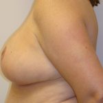 Breast Reduction Before & After Patient #1094