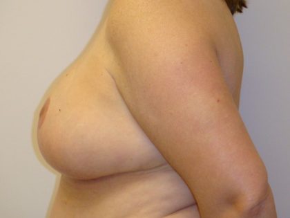 Breast Reduction Before & After Patient #1094