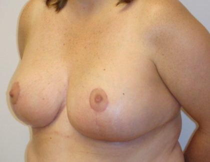 Breast Reduction Before & After Patient #1094