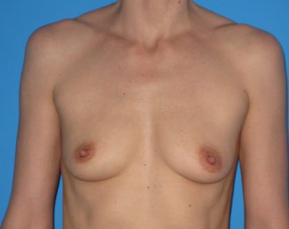 Breast Augmentation Before & After Patient #954