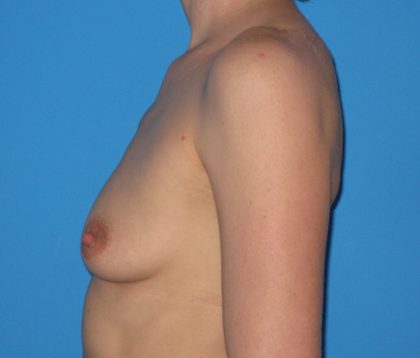 Breast Augmentation Before & After Patient #954