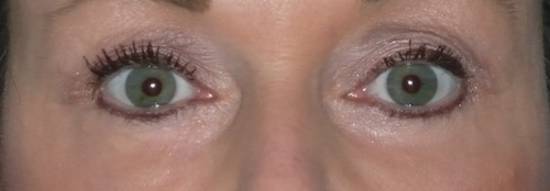 CO2 Laser Before & After Patient #1437