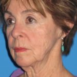 Facelift Before & After Patient #1458