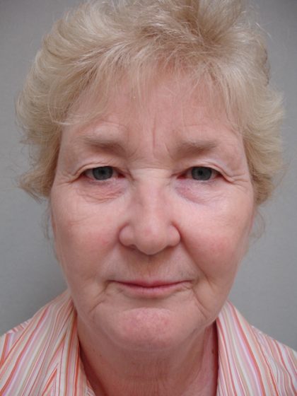 Facelift Before & After Patient #1465