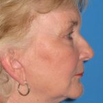 Facelift Before & After Patient #1465
