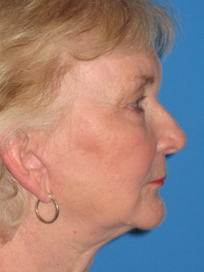 Facelift Before & After Patient #1465