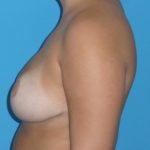Breast Reduction Before & After Patient #1105