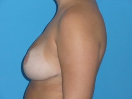 Breast Reduction Before & After Patient #1105