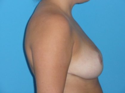 Breast Reduction Before & After Patient #1105