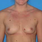 Breast Augmentation Before & After Patient #965