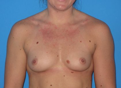 Breast Augmentation Before & After Patient #965