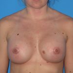 Breast Augmentation Before & After Patient #965