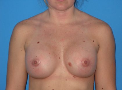 Breast Augmentation Before & After Patient #965