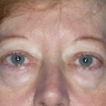 Blepharoplasty Before & After Patient #1399