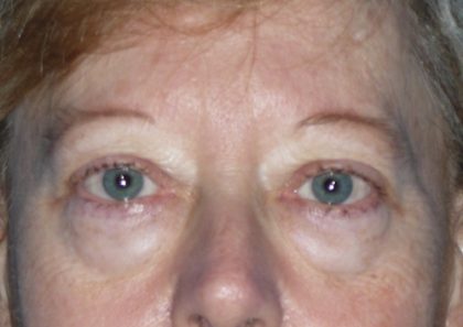 Blepharoplasty Before & After Patient #1399