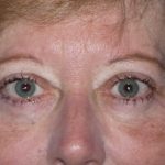 Blepharoplasty Before & After Patient #1399
