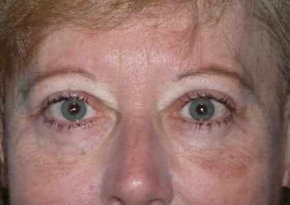 Blepharoplasty Before & After Patient #1399