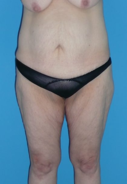 Patient #1256 Body Lift Before and After Photos Baltimore, Maryland - Plastic  Surgery Gallery Dr. Alyson Wells