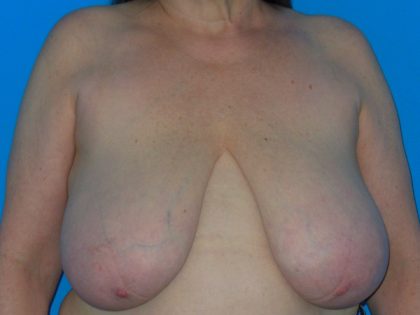 Breast Reduction Before & After Patient #1116