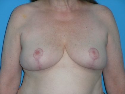 Breast Reduction Before & After Patient #1116