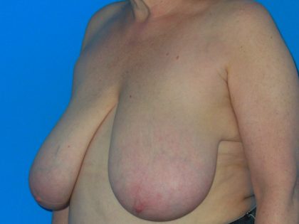 Breast Reduction Before & After Patient #1116