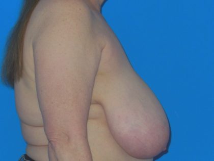 Breast Reduction Before & After Patient #1116