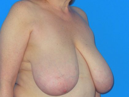 Breast Reduction Before & After Patient #1116