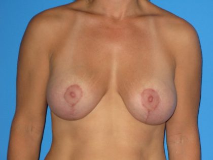 Breast Augmentation with Lift Before & After Patient #1023