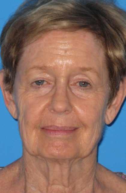 Facelift Before & After Patient #1472