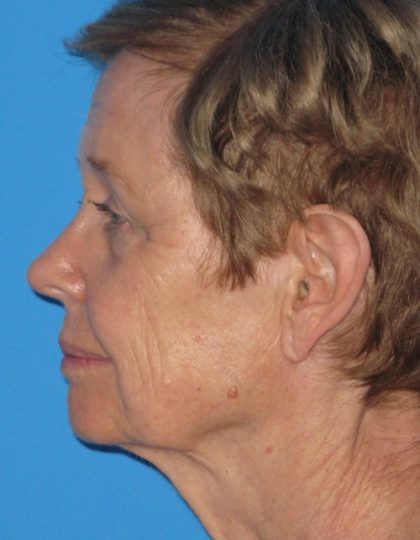 Facelift Before & After Patient #1472