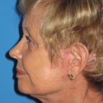 Facelift Before & After Patient #1472