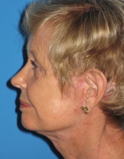 Facelift Before & After Patient #1472