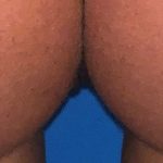 Labiaplasty Before & After Patient #1494