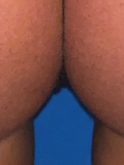 Labiaplasty Before & After Patient #1494