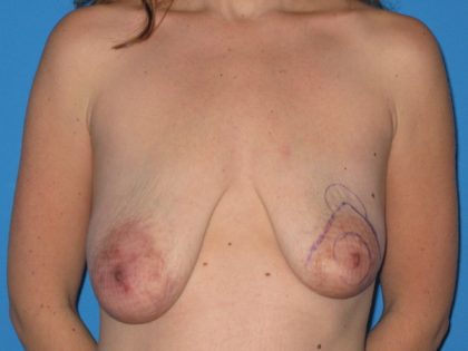 Breast Augmentation with Lift Before & After Patient #1034
