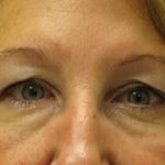 Blepharoplasty Before & After Patient #1402