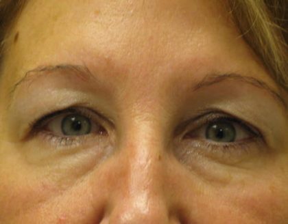 Blepharoplasty Before & After Patient #1402