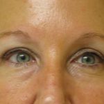 Blepharoplasty Before & After Patient #1402