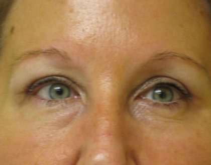 Blepharoplasty Before & After Patient #1402