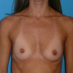 Breast Augmentation Before & After Patient #972