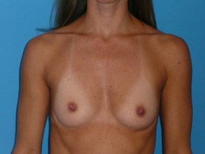 Breast Augmentation Before & After Patient #972