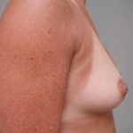 Breast Augmentation Before & After Patient #983