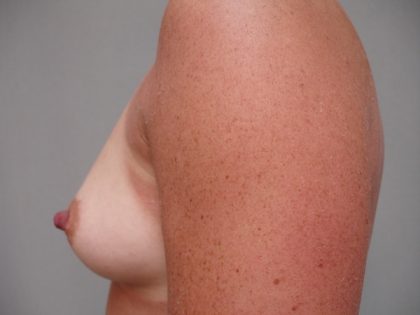 Breast Augmentation Before & After Patient #983