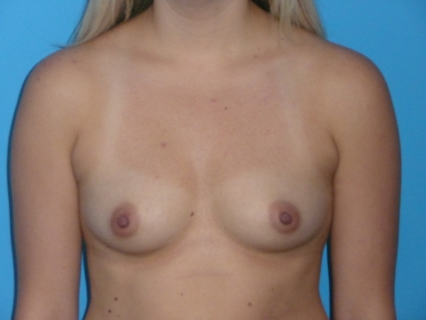 Breast Augmentation Before & After Patient #994