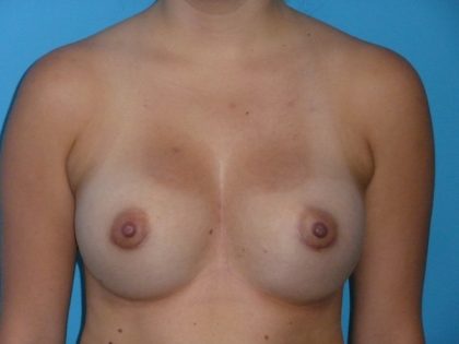 Breast Augmentation Before & After Patient #994