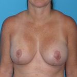 Breast Augmentation with Lift Before & After Patient #1041