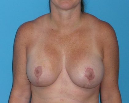 Breast Augmentation with Lift Before & After Patient #1041